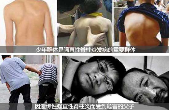 郑州痛风风湿病医院强直性脊柱炎给患者身体带来伤害.jpg
