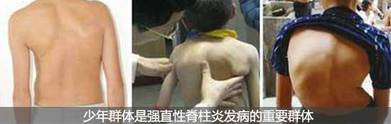 郑州痛风风湿病医院少年儿童成为强直发病的重要目标.jpg