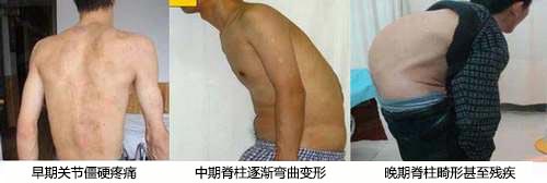 郑州痛风风湿病医院强直性脊柱炎不同时期症状表现.jpg