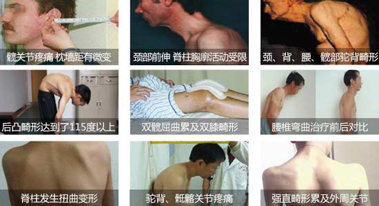 郑州痛风风湿病医院强直性脊柱炎给患者身体带来危害.jpg