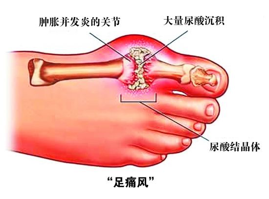 郑州痛风风湿病医院足部痛风尿酸结晶体的形成.jpg
