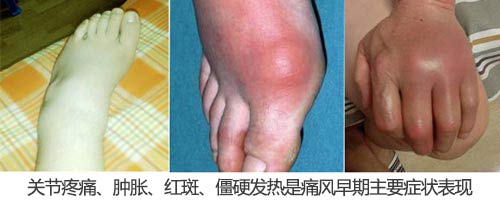 郑州痛风风湿病医院痛风早期主要症状.jpg